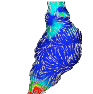 Computational Fluid Dynamics (CFD) used in patient specific modelling. - Professor Peter Hoskins